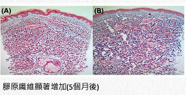 膠原纖維增生圖